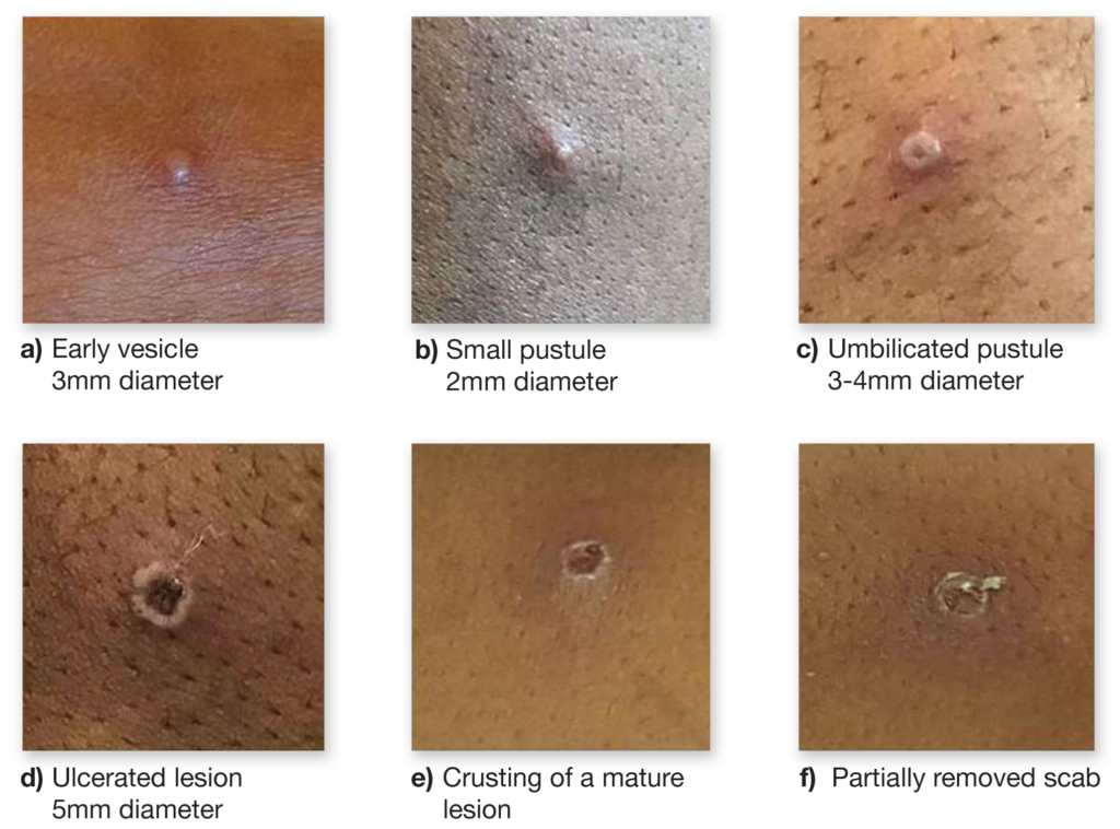 A series of 6 images from an early Mpox vesicle to a partially removed scab.